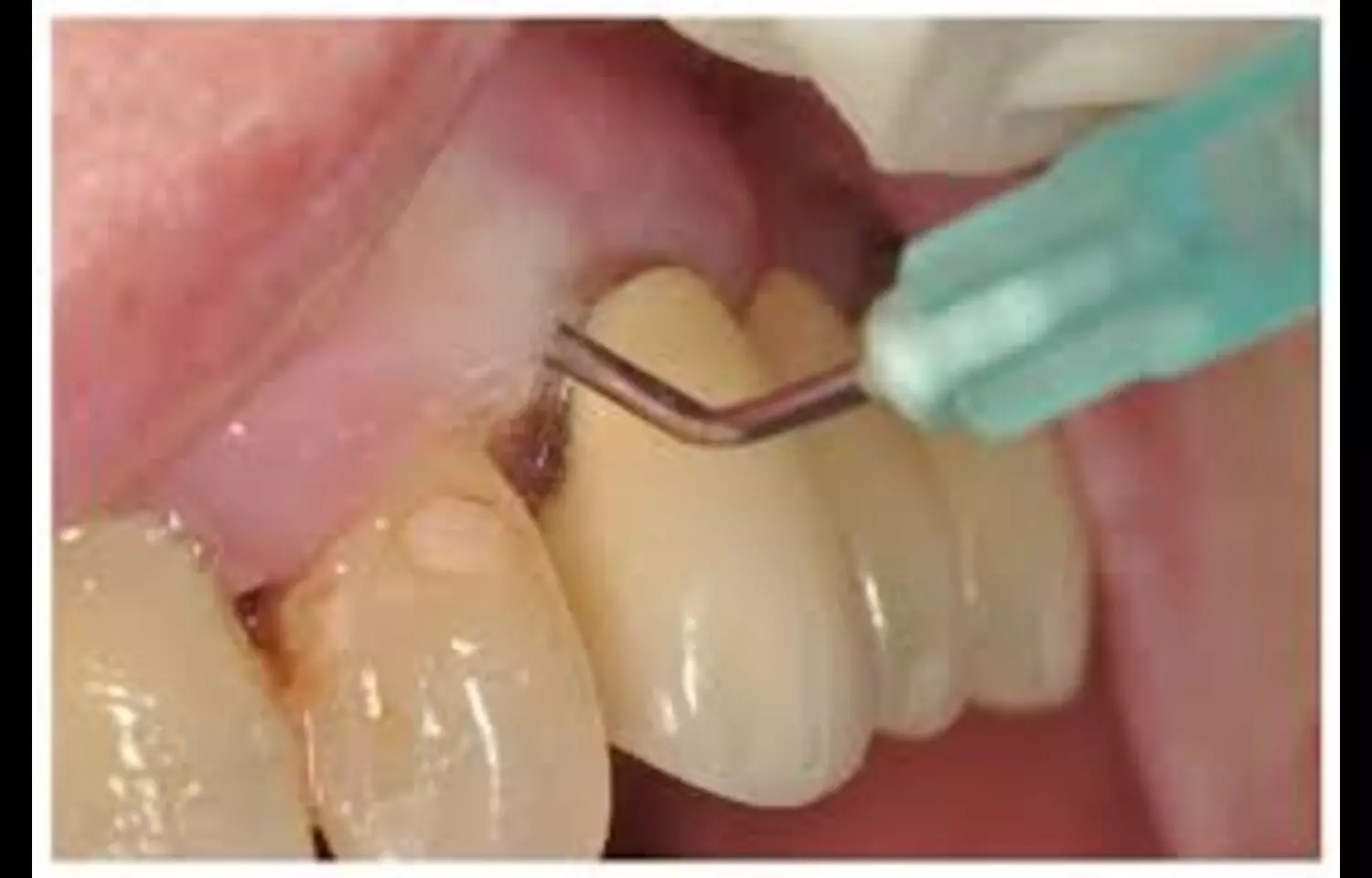 You are currently viewing Ozonated Water Shows Modest Benefits in Periodontal Therapy: Study