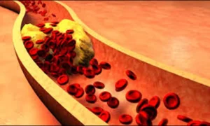 Read more about the article TyG-BMI Index Predicts Higher Mortality Risk in Osteoporosis Patients: Study