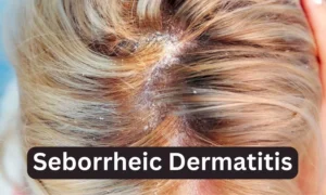 Read more about the article Study Reveals Two-Way Link Between Seborrheic Dermatitis and Other Barrier Diseases