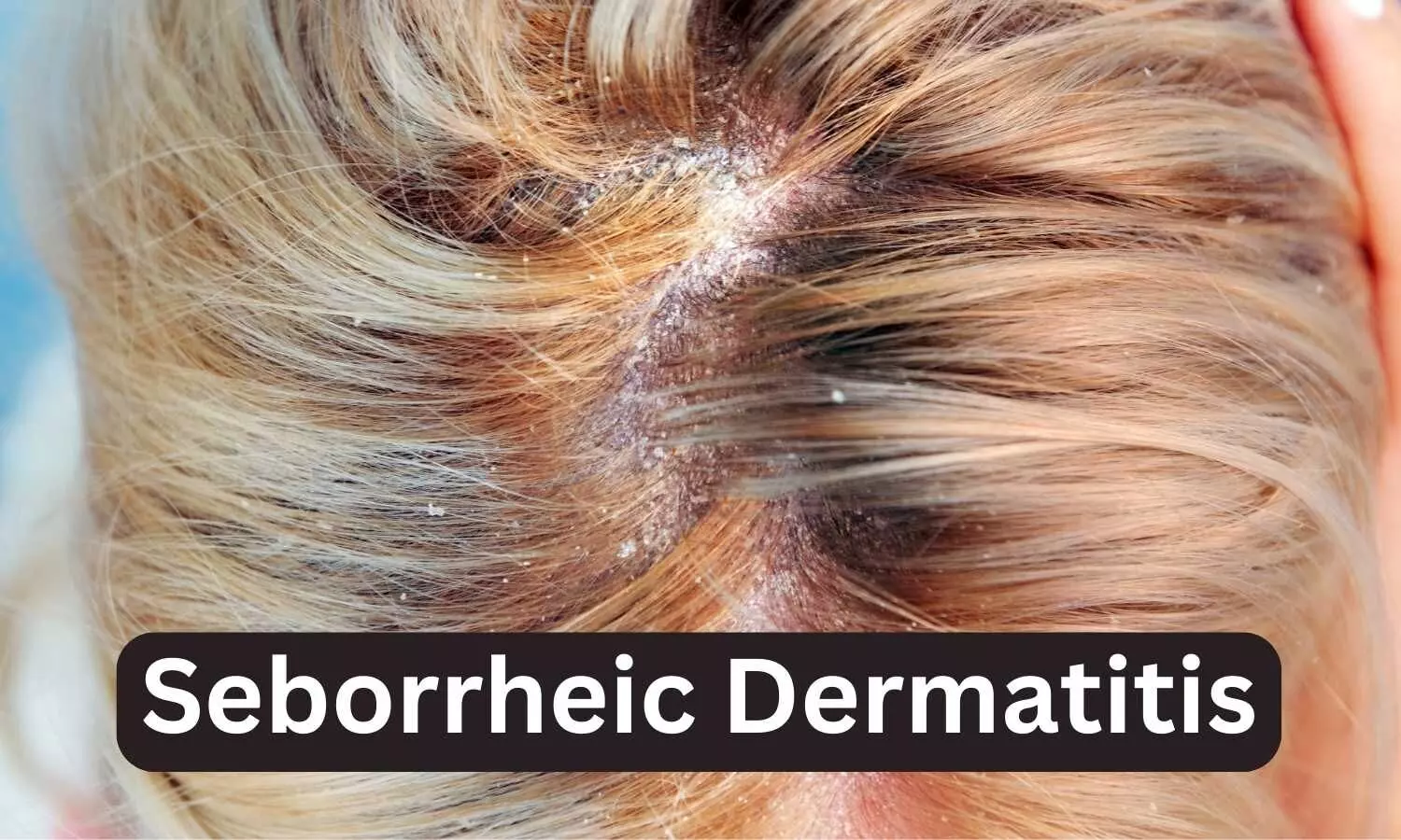You are currently viewing Study Reveals Two-Way Link Between Seborrheic Dermatitis and Other Barrier Diseases