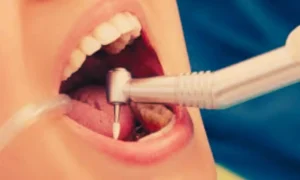 Read more about the article MA-T Shows Potential as Safer, Effective Root Canal Irrigant compared to sodium hypochlorite: Study