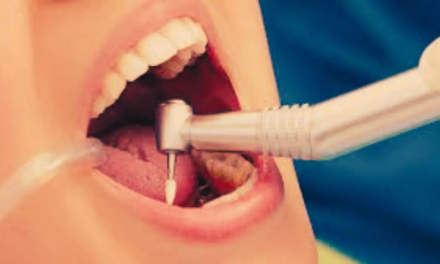 You are currently viewing MA-T Shows Potential as Safer, Effective Root Canal Irrigant compared to sodium hypochlorite: Study