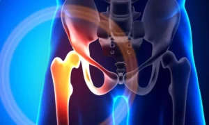 Read more about the article Anesthesiologist-Led Care Speeds Hip-Fracture Surgery and Reduces Complications: Study