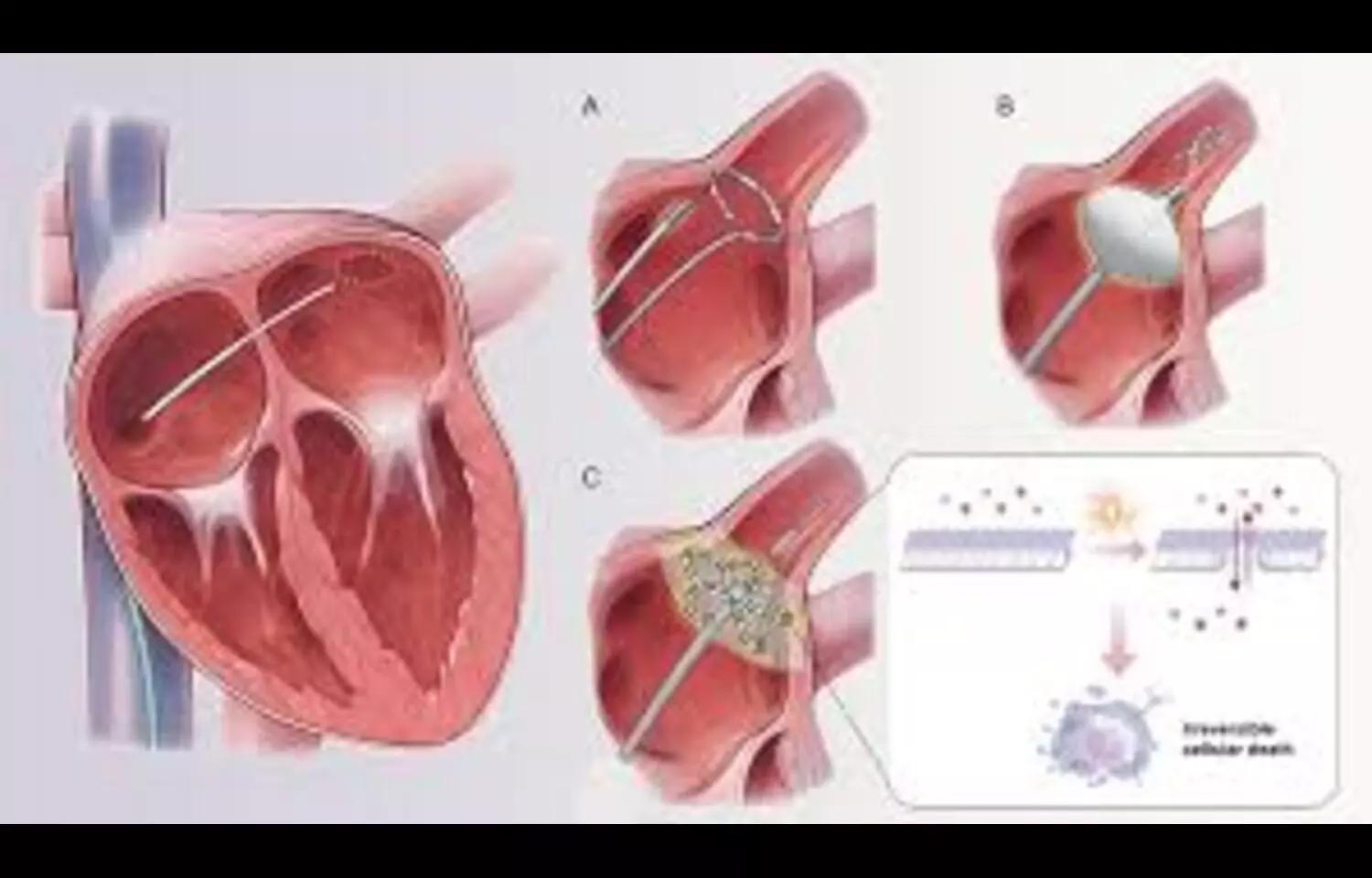 Read more about the article First-in-Human Study Shows Promise for High-Voltage PFA in Treating Scar-Related ventricular tachycardia: Study