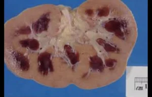 Read more about the article Acute Kidney Injury in CCU Patients Increases Mortality and Hospital Stay: Study