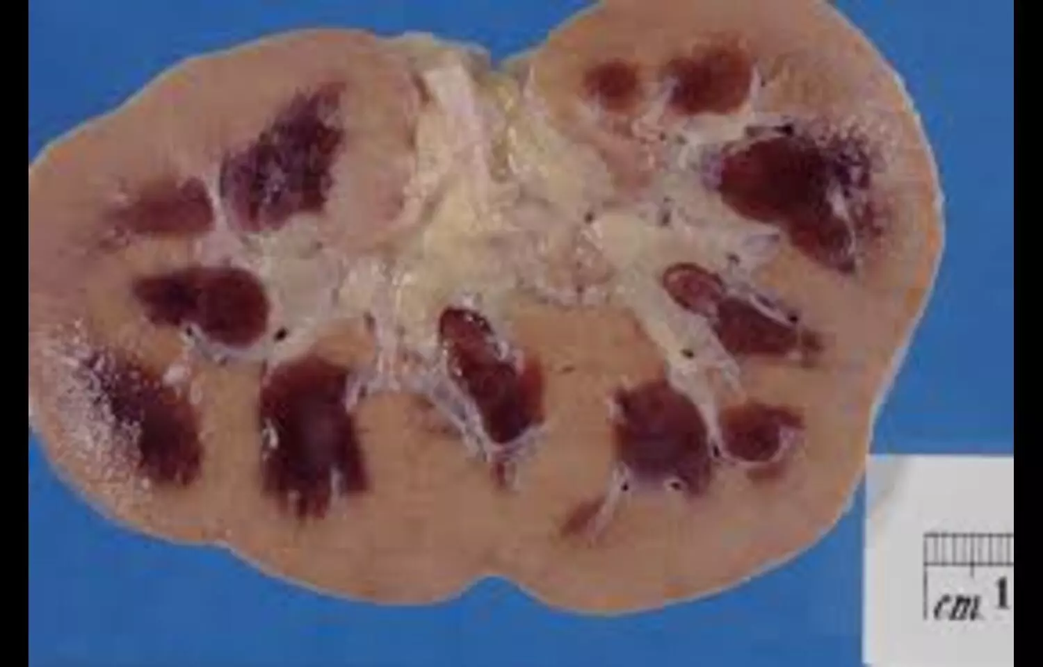 You are currently viewing Acute Kidney Injury in CCU Patients Increases Mortality and Hospital Stay: Study