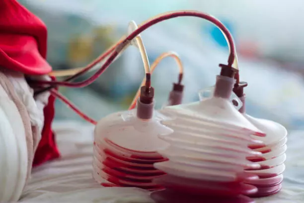 You are currently viewing Oral TXA as effective and safe as IV TXA in hip and knee arthroplasty: study