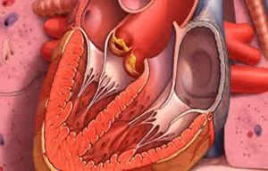 Read more about the article Female Patients with Culture-Negative Endocarditis Face Worse Prognosis,  suggests study