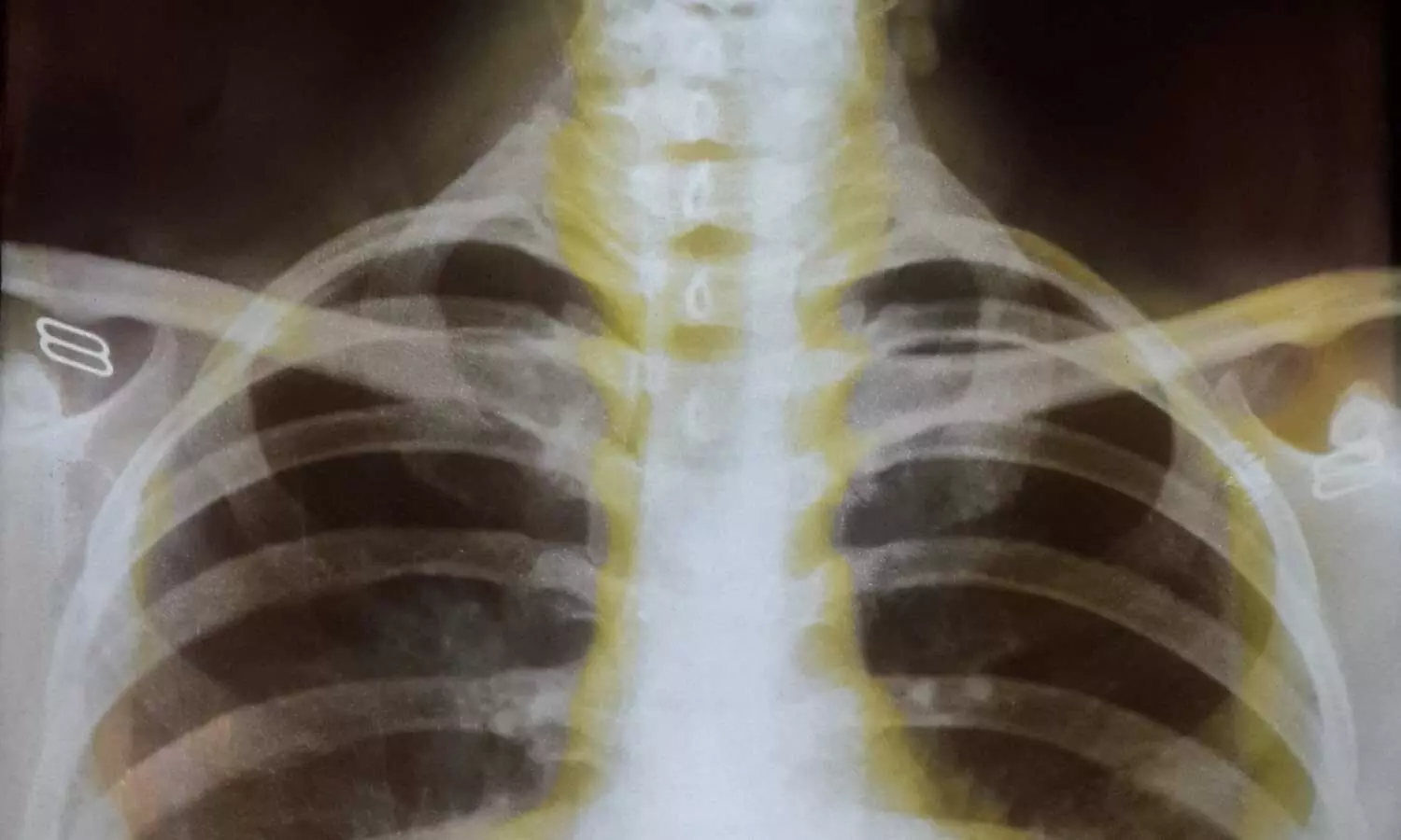 You are currently viewing AI detects hidden objects on chest scans better than radiologists, reveals research