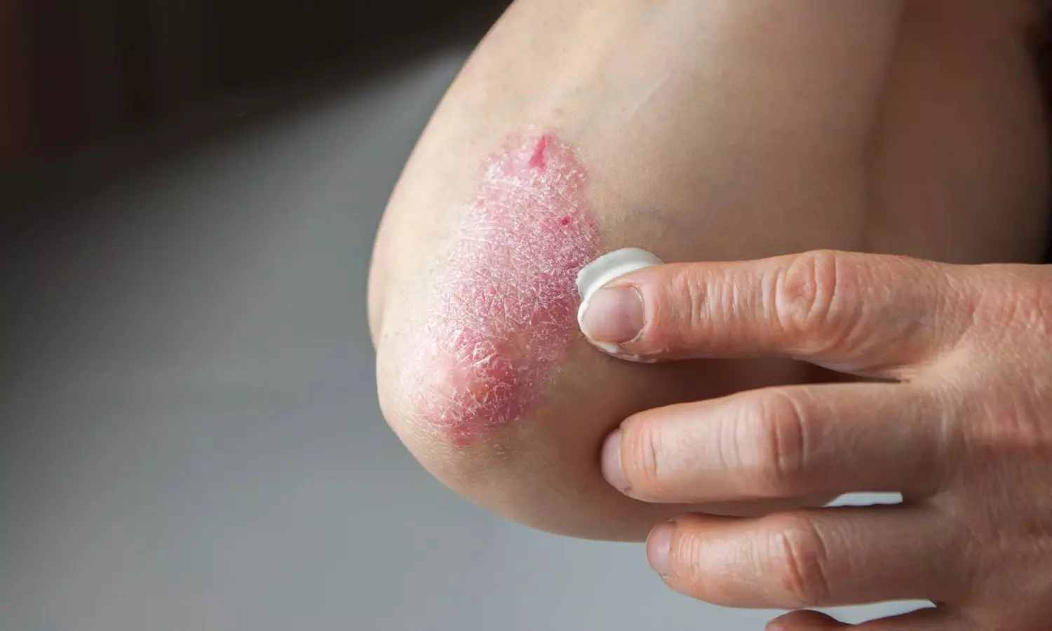 Read more about the article Patients with coexisting psoriasis and diabetes face elevated all-cause mortality risk: Study