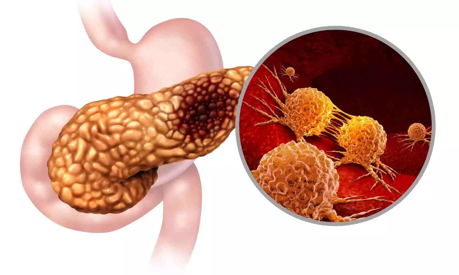 Read more about the article AI Detects Pancreatic Cancer More Accurately Than Radiologists, Finds Research