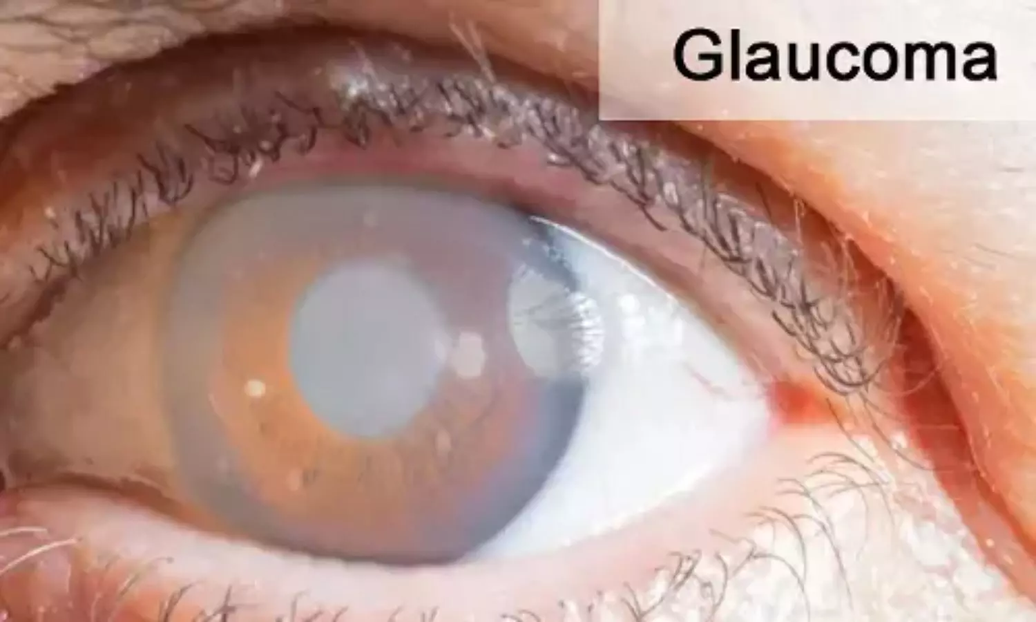 You are currently viewing Muscle isolation linked to ptosis and strabismus after glaucoma surgery, suggests study