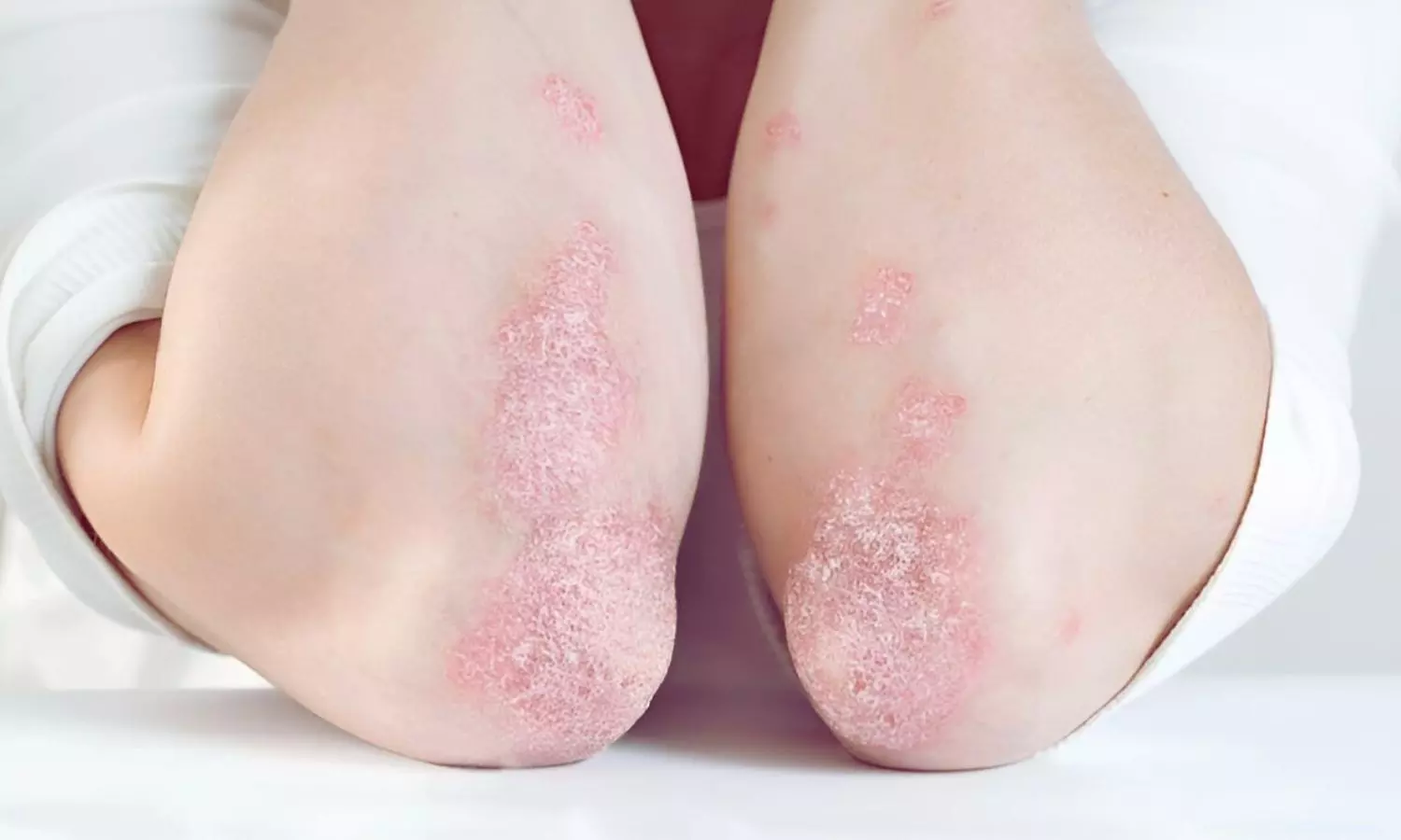 You are currently viewing Secukinumab Offers Better Psychological Benefits in Psoriasis Treatment: Study