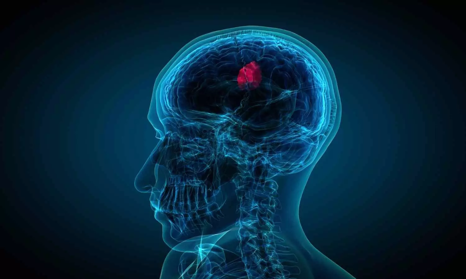 You are currently viewing Nasal drops fight brain tumors noninvasively,  states study