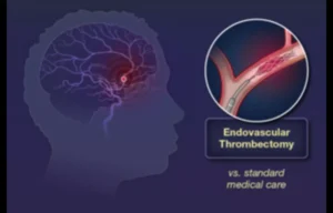 Read more about the article Patients undergoing endovascular Thrombectomy for Large Vessel Occlusion Stroke under GA had improved outcomes: JAMA