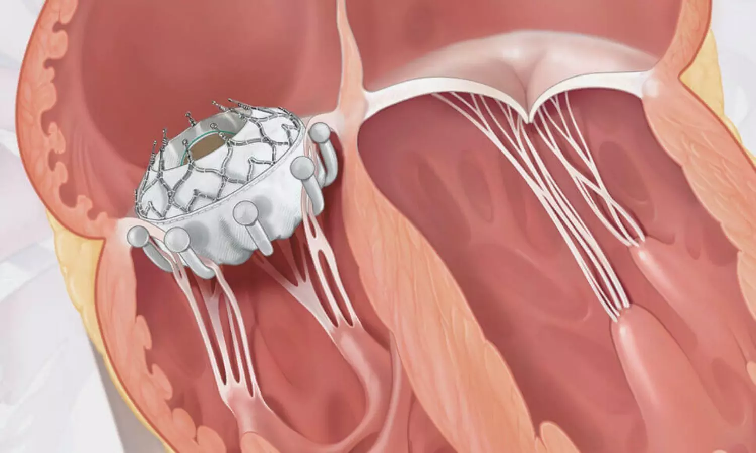 Read more about the article EVOQUE TTVR Delivers Promising Real-World Results: Over 97 Percent Achieve TR Elimination