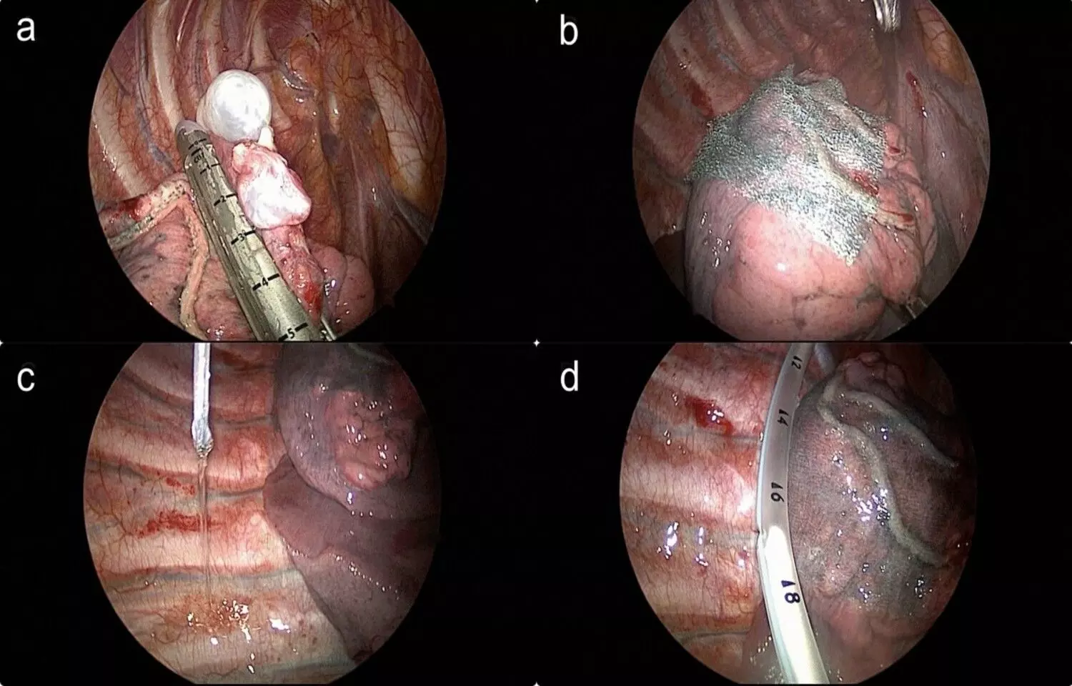 You are currently viewing IPLD Useful Adjunct to thoracoscopic bullectomy with pleurodesis for 
Preventing Pneumothorax Recurrence: Study