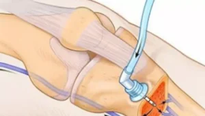 Read more about the article Intraosseous cefuroxime achieved higher local tissue concentrations than IV injection in TKA: study