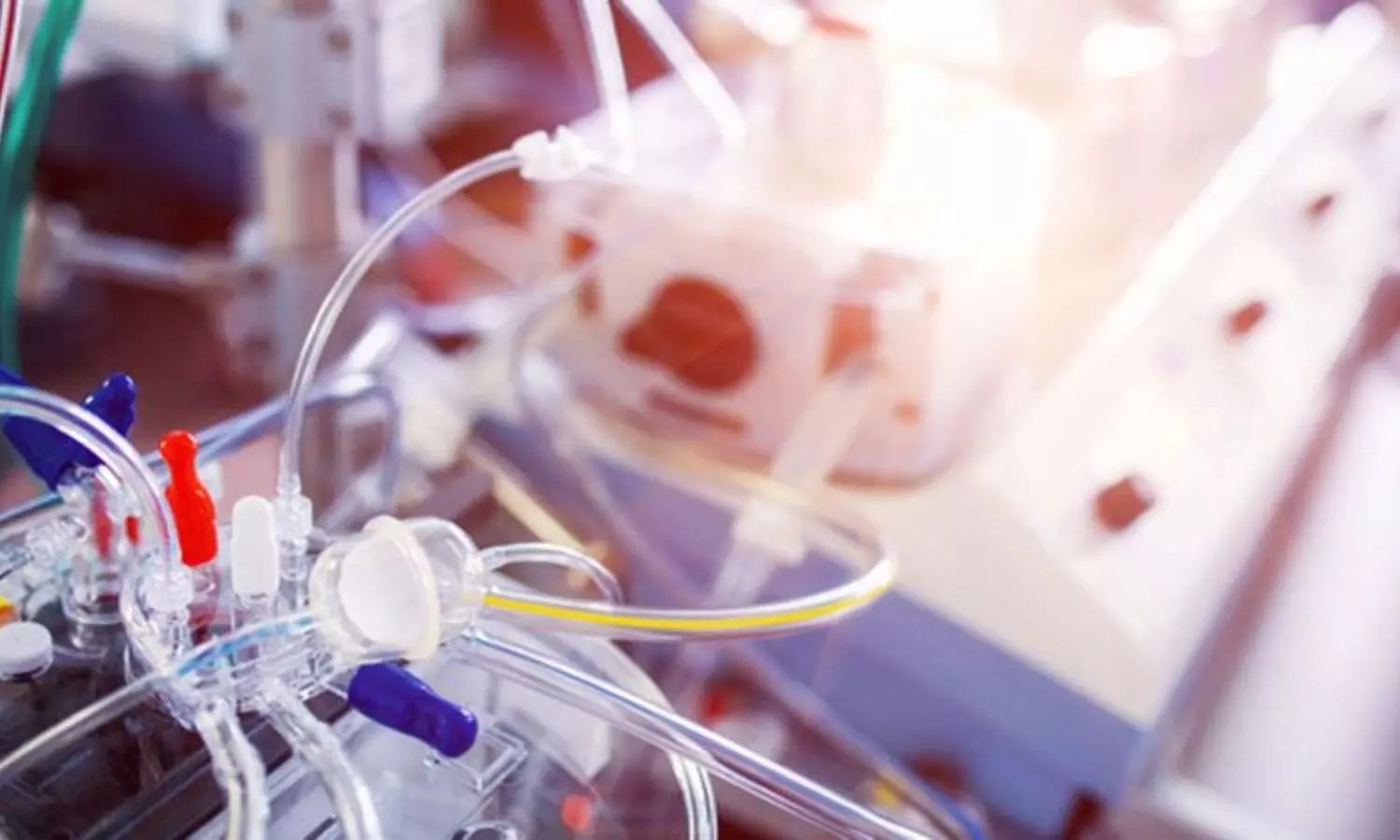 You are currently viewing Levosimendan Fails to Improve ECMO Weaning in Severe Cardiogenic Shock, LEVOECMO Trial Reports