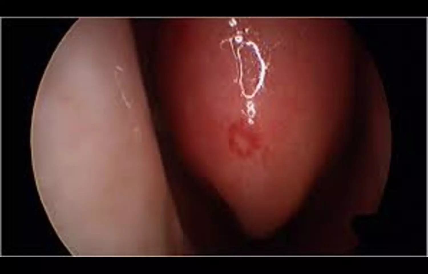 You are currently viewing Engasertib Shows Favorable Safety Profile and Reduces Epistaxis in hereditary hemorrhagic telegenctasia: Study