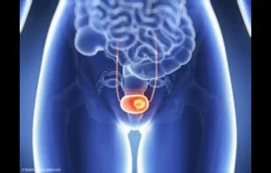 Read more about the article Early Bedside removal of Ureteral Stent feasible and safe during kidney transplantation: Study