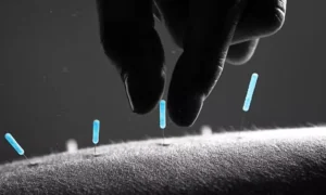 Read more about the article Acupuncture targets mast cells and inflammatory cascade to reduce allergic disorders: Study