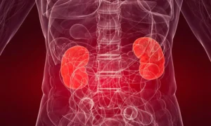 Read more about the article TIPS in Decompensated Cirrhosis Patients Linked to Acute Kidney Injury: Study