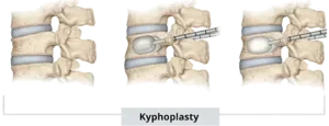 Read more about the article Optimizing Anesthetic Techniques for Percutaneous Kyphoplasty: A Comparative Study of TPVB and Local Infiltration