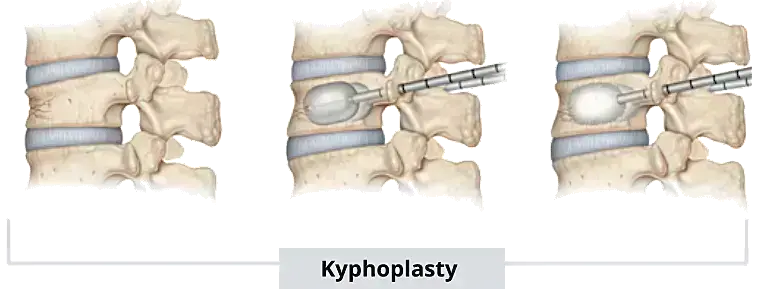 You are currently viewing Optimizing Anesthetic Techniques for Percutaneous Kyphoplasty: A Comparative Study of TPVB and Local Infiltration