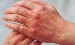 Read more about the article Tralokinumab Shows Sustained Efficacy in Hand Atopic Dermatitis: Study