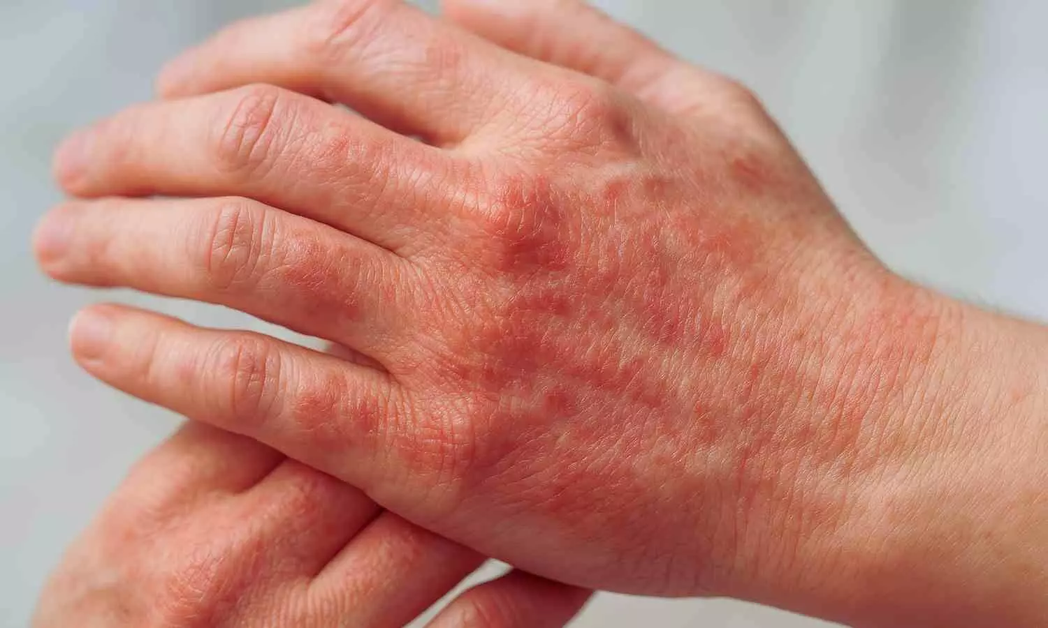 Read more about the article Tralokinumab Shows Sustained Efficacy in Hand Atopic Dermatitis: Study