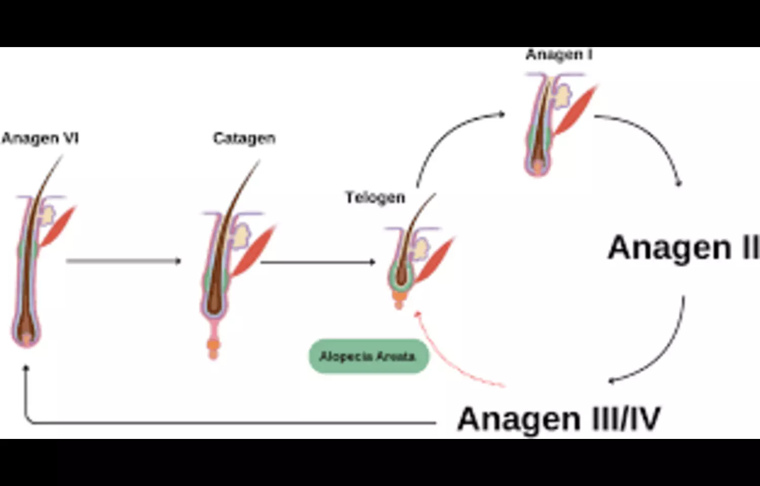 Read more about the article Blood Metabolites May Have Causal Links with Alopecia Areata: Study