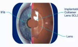 Read more about the article Vertical ICL Fixation Delivers Safer, More Predictable Vault Outcomes: Study Finds