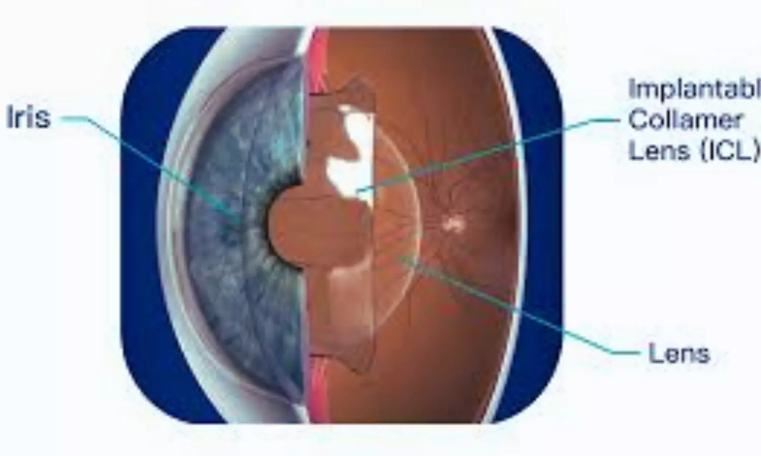 You are currently viewing Vertical ICL Fixation Delivers Safer, More Predictable Vault Outcomes: Study Finds