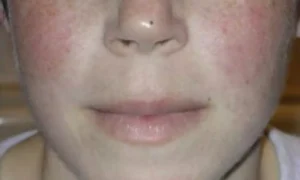 Read more about the article Telitacicept Matches Belimumab in Controlling Childhood Lupus, Study Finds