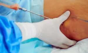 Read more about the article AI Model Accurately Predicts Blood Loss During Liposuction, Improves Safety: Study