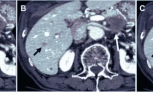 Read more about the article Deep Learning Boosts Image Quality in Low-Dose CT Portal Venography: Study Shows