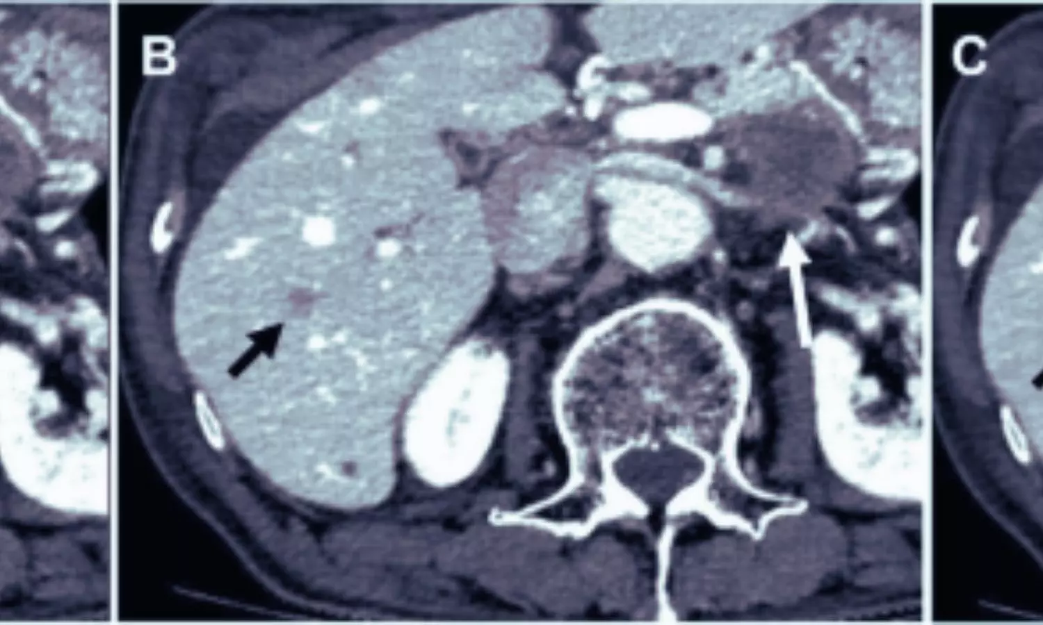 You are currently viewing Deep Learning Boosts Image Quality in Low-Dose CT Portal Venography: Study Shows
