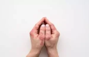 Read more about the article Deucravacitinib Shows Durable Efficacy in Psoriasis Over 2 Years, finds study