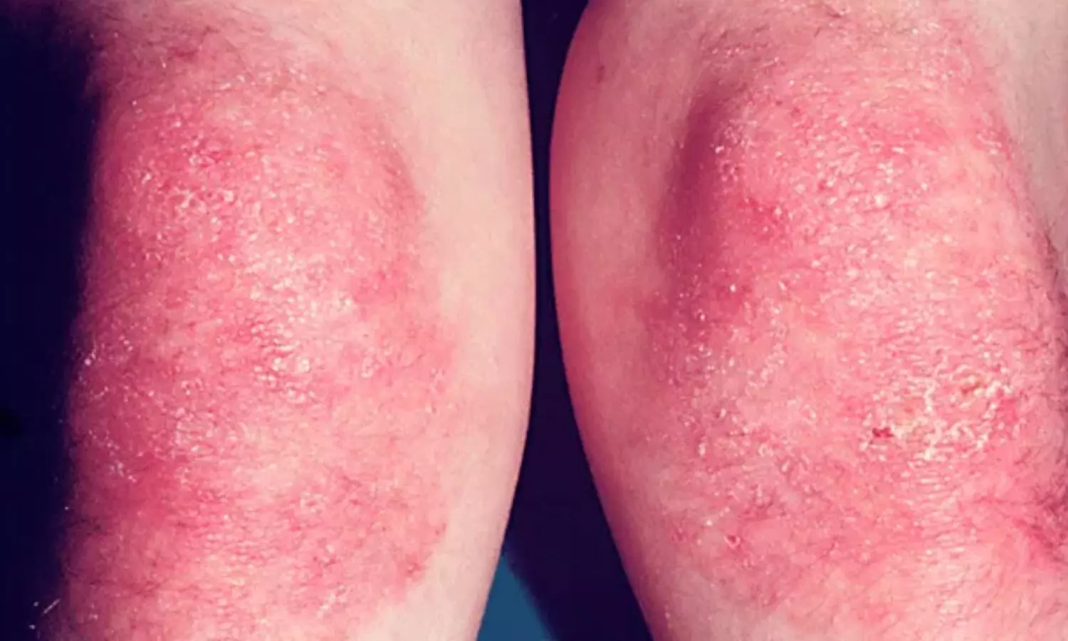 You are currently viewing MMF-Based Regimen Shows Potential as Treatment Option for juvenile dermatomyositis: JAMA