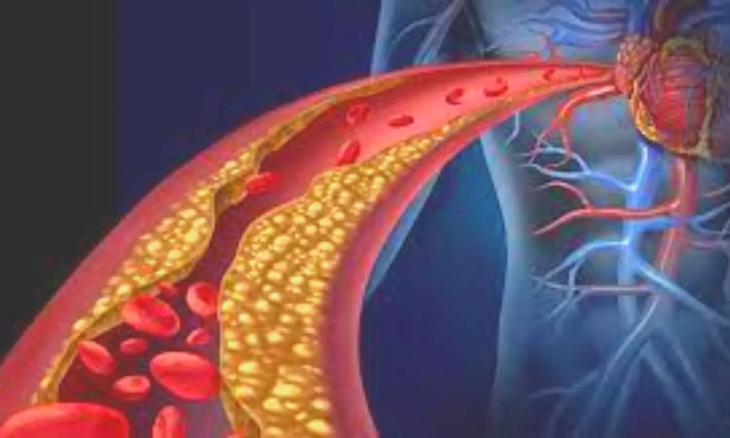 CT Angiography in Extreme Coronary Artery Calcium Score: JACC Adv., February 2026