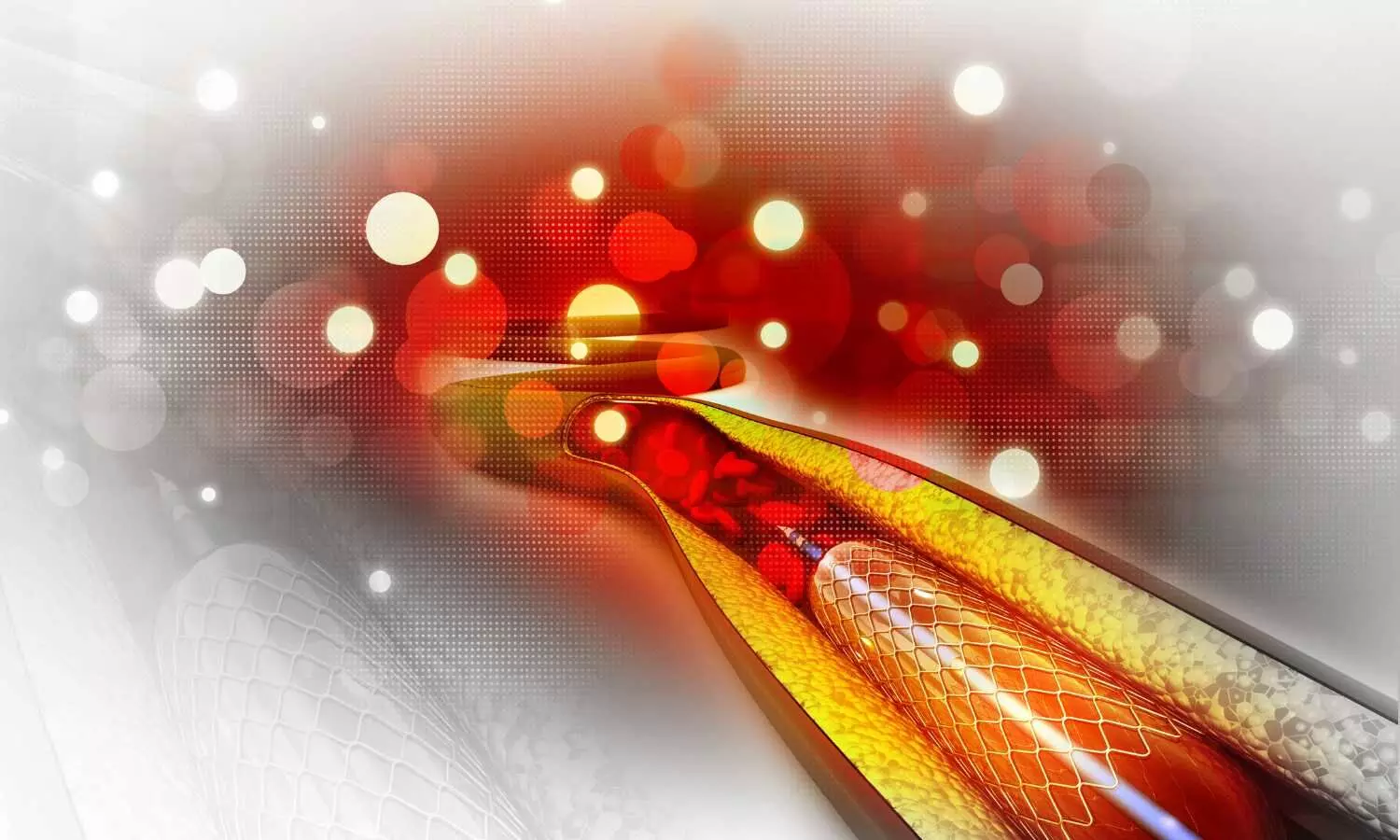 Ultrathin Biodegradable Polymer Stents Prove Effective Alternative in Routine PCI: IHJ 2025 Study Confirms