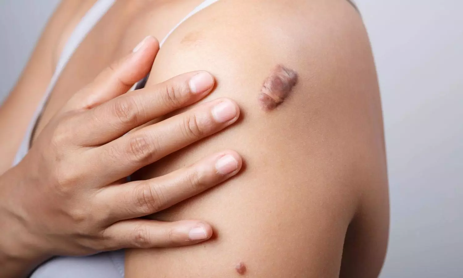 You are currently viewing Postoperative Radiotherapy Significantly Reduces Keloid Recurrence Compared to Surgery Alone: Study