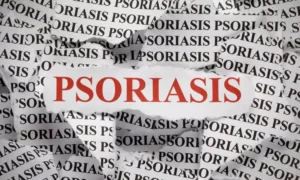 Read more about the article New gene discovery paves way for tailored psoriasis treatments,  reveals research
