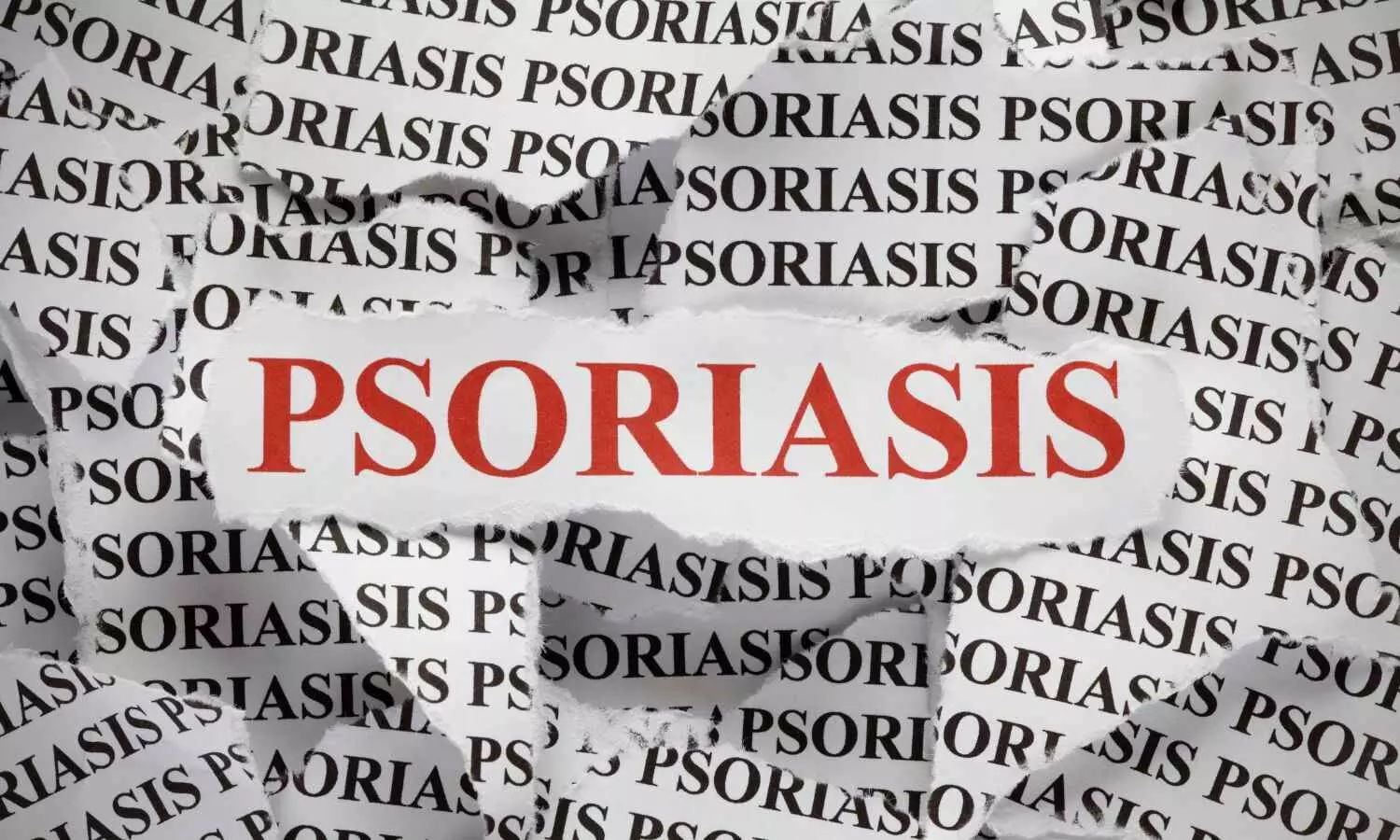 Read more about the article New gene discovery paves way for tailored psoriasis treatments,  reveals research