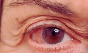 Read more about the article Study Finds Modest but Significant Alzheimer’s Risk in Patients With Glaucoma