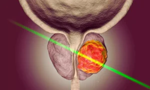 Read more about the article Focal Laser Ablation Offers Oncological and Functional Control Compared to Other Focal Therapies: Study