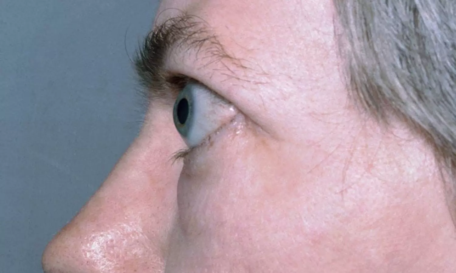 Read more about the article Smoking Increases Graves’ Disease Severity and Relapse Risk: Study