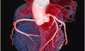 Read more about the article Microvascular Resistance Index: November 2025, AJC Study Reveals New Prognostic Tool for Heart Attack Patients