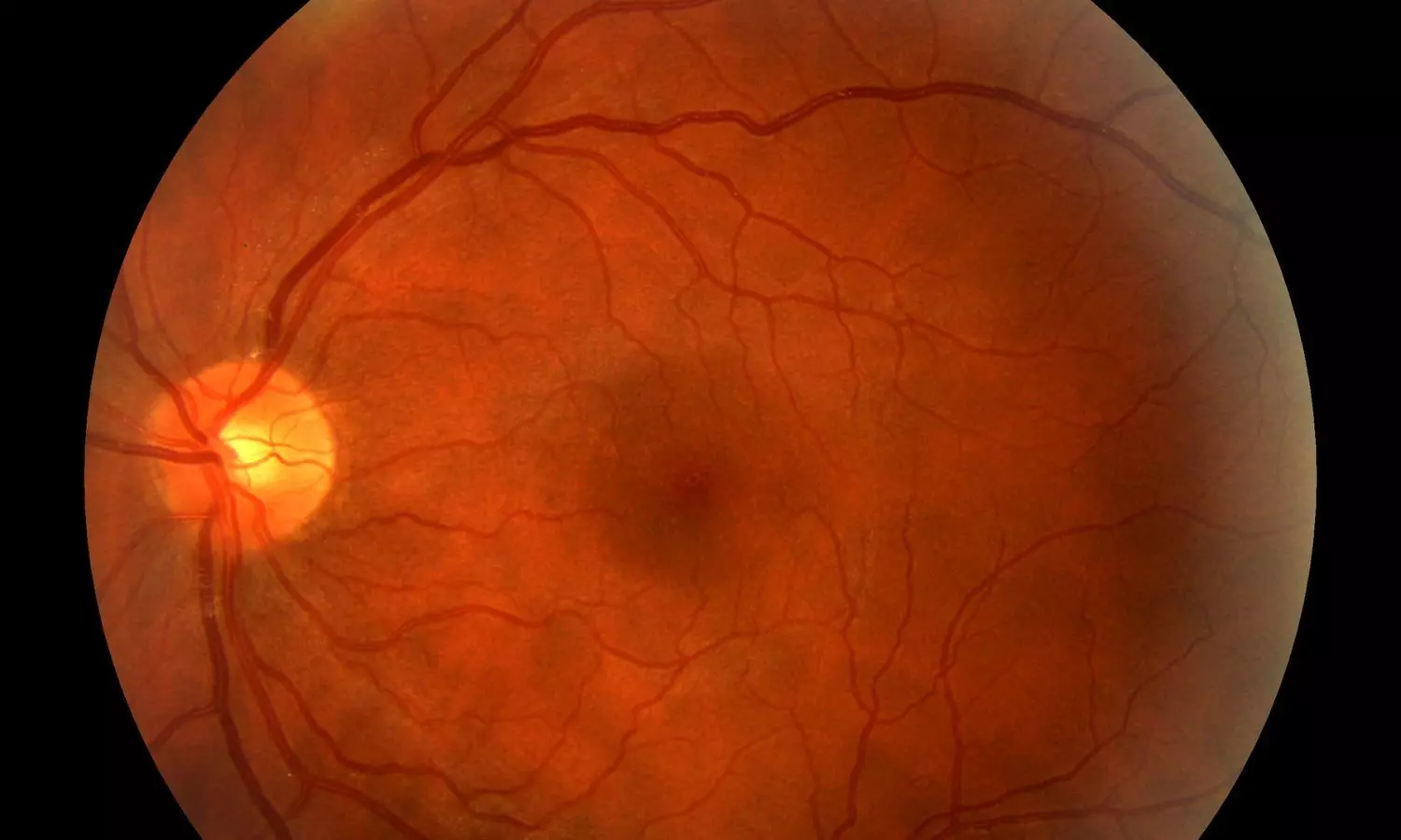 Read more about the article Long-Term Hydroxychloroquine Use Tied to Risk of Retinopathy, Reiterates Study